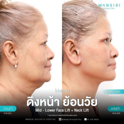 ดึงหน้า, ดึงหน้า ชั้นลึก, Face Lift, Deep Plane Facelift, Neck Lift