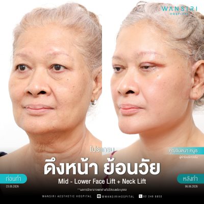 ดึงหน้า, ดึงหน้า ชั้นลึก, Face Lift, Deep Plane Facelift, Neck Lift