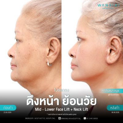 ดึงหน้า, ดึงหน้า ชั้นลึก, Face Lift, Deep Plane Facelift, Neck Lift