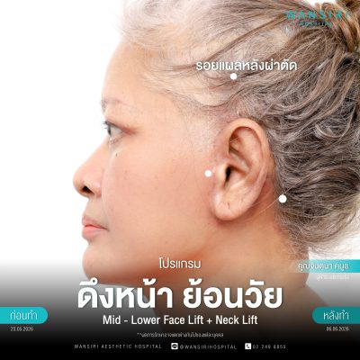 ดึงหน้า, ดึงหน้า ชั้นลึก, Face Lift, Deep Plane Facelift, Neck Lift