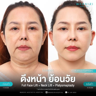 ดึงหน้า, ดึงหน้า ชั้นลึก, Face Lift, Deep Plane Facelift, Neck Lift