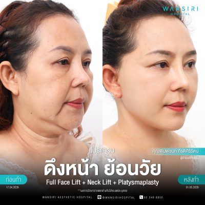 ดึงหน้า, ดึงหน้า ชั้นลึก, Face Lift, Deep Plane Facelift, Neck Lift