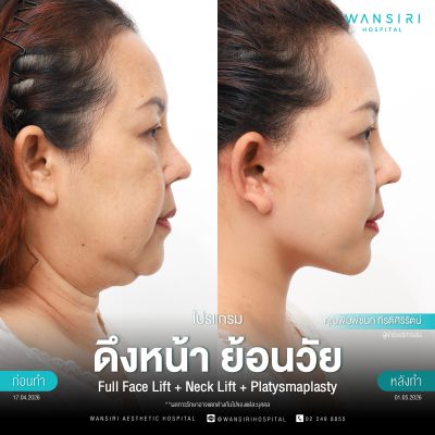 ดึงหน้า, ดึงหน้า ชั้นลึก, Face Lift, Deep Plane Facelift, Neck Lift