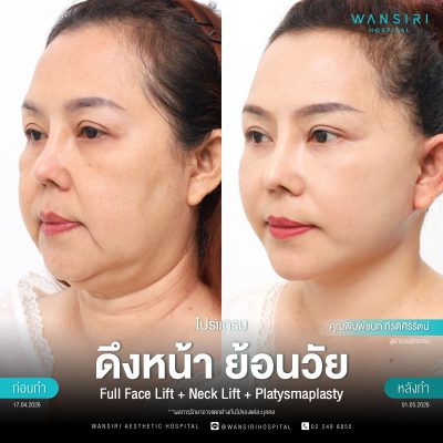 ดึงหน้า, ดึงหน้า ชั้นลึก, Face Lift, Deep Plane Facelift, Neck Lift