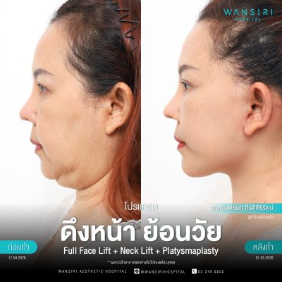 ดึงหน้า, ดึงหน้า ชั้นลึก, Face Lift, Deep Plane Facelift, Neck Lift