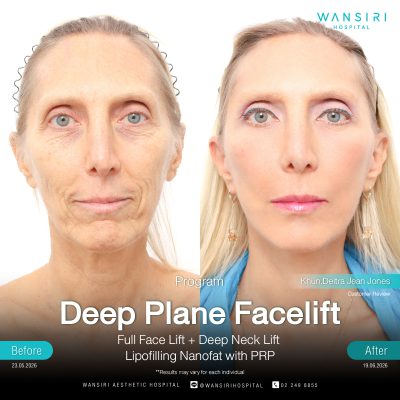 Deep Plane Facelift in Bangkok | Face Lift & Neck Lift | Wansiri Hospital