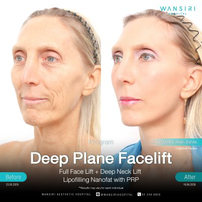 Deep Plane Facelift in Bangkok | Face Lift & Neck Lift | Wansiri Hospital
