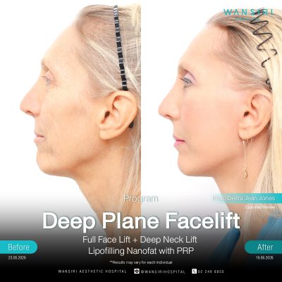 Deep Plane Facelift in Bangkok | Face Lift & Neck Lift | Wansiri Hospital