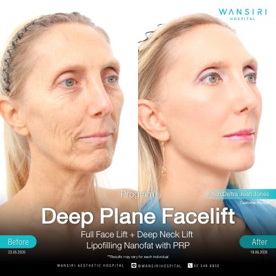 Deep Plane Facelift in Bangkok | Face Lift & Neck Lift | Wansiri Hospital