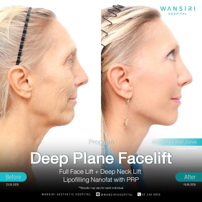 Deep Plane Facelift in Bangkok | Face Lift & Neck Lift | Wansiri Hospital