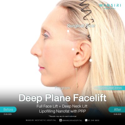 Deep Plane Facelift in Bangkok | Face Lift & Neck Lift | Wansiri Hospital