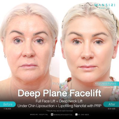 Deep Plane Facelift in Bangkok | Face Lift & Neck Lift | Wansiri Hospital
