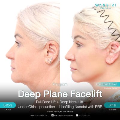 Deep Plane Facelift in Bangkok | Face Lift & Neck Lift | Wansiri Hospital