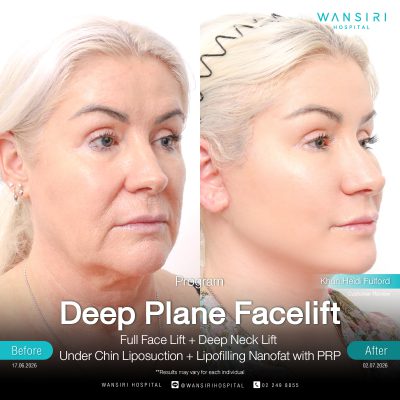 Deep Plane Facelift in Bangkok | Face Lift & Neck Lift | Wansiri Hospital