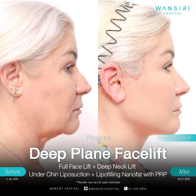 Deep Plane Facelift in Bangkok | Face Lift & Neck Lift | Wansiri Hospital