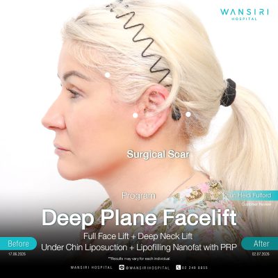 Deep Plane Facelift in Bangkok | Face Lift & Neck Lift | Wansiri Hospital