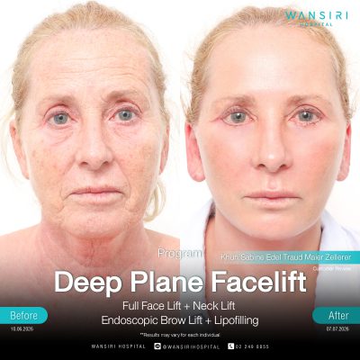 Deep Plane Facelift in Bangkok | Face Lift & Neck Lift | Wansiri Hospital