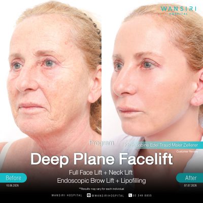 Deep Plane Facelift in Bangkok | Face Lift & Neck Lift | Wansiri Hospital