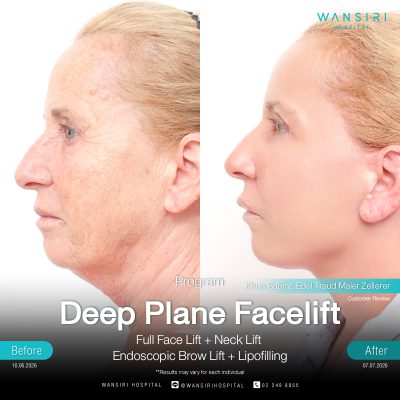 Deep Plane Facelift in Bangkok | Face Lift & Neck Lift | Wansiri Hospital