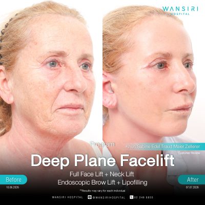 Deep Plane Facelift in Bangkok | Face Lift & Neck Lift | Wansiri Hospital