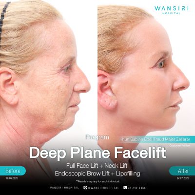 Deep Plane Facelift in Bangkok | Face Lift & Neck Lift | Wansiri Hospital