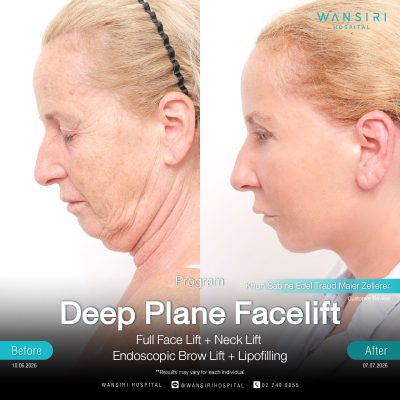 Deep Plane Facelift in Bangkok | Face Lift & Neck Lift | Wansiri Hospital