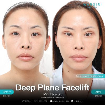 Deep Plane Facelift in Bangkok | Face Lift & Neck Lift | Wansiri Hospital
