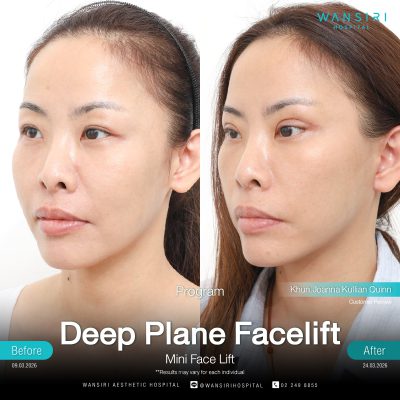 Deep Plane Facelift in Bangkok | Face Lift & Neck Lift | Wansiri Hospital