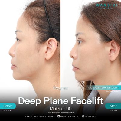 Deep Plane Facelift in Bangkok | Face Lift & Neck Lift | Wansiri Hospital