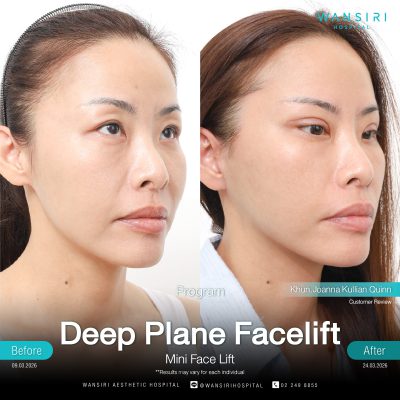 Deep Plane Facelift in Bangkok | Face Lift & Neck Lift | Wansiri Hospital