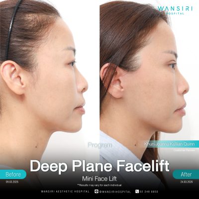 Deep Plane Facelift in Bangkok | Face Lift & Neck Lift | Wansiri Hospital