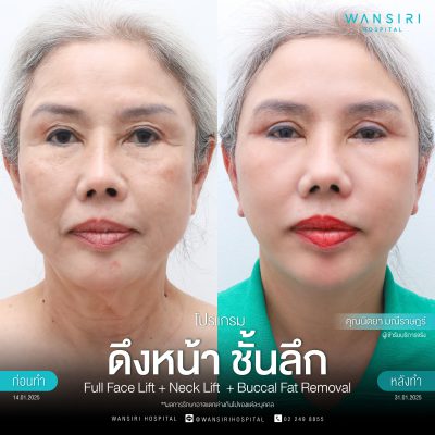 ดึงหน้า, ดึงหน้า ชั้นลึก, Face Lift, Deep Plane Facelift, Neck Lift