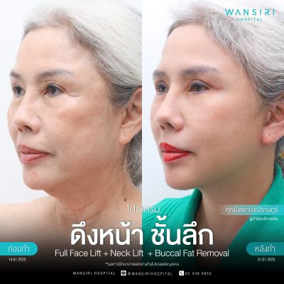 ดึงหน้า, ดึงหน้า ชั้นลึก, Face Lift, Deep Plane Facelift, Neck Lift