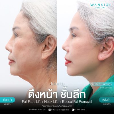 ดึงหน้า, ดึงหน้า ชั้นลึก, Face Lift, Deep Plane Facelift, Neck Lift