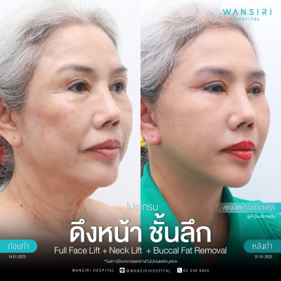 ดึงหน้า, ดึงหน้า ชั้นลึก, Face Lift, Deep Plane Facelift, Neck Lift