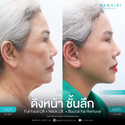 ดึงหน้า, ดึงหน้า ชั้นลึก, Face Lift, Deep Plane Facelift, Neck Lift