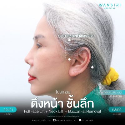 ดึงหน้า, ดึงหน้า ชั้นลึก, Face Lift, Deep Plane Facelift, Neck Lift