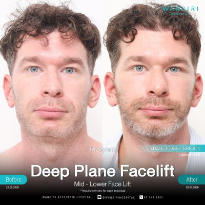 Deep Plane Facelift in Bangkok | Face Lift & Neck Lift | Wansiri Hospital