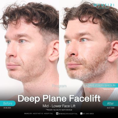 Deep Plane Facelift in Bangkok | Face Lift & Neck Lift | Wansiri Hospital