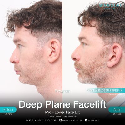 Deep Plane Facelift in Bangkok | Face Lift & Neck Lift | Wansiri Hospital