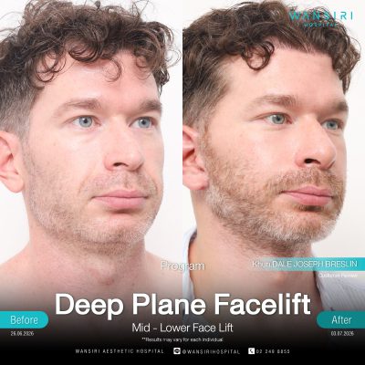 Deep Plane Facelift in Bangkok | Face Lift & Neck Lift | Wansiri Hospital