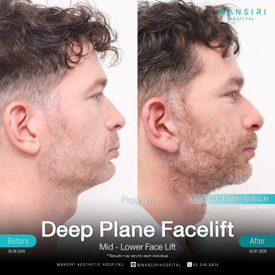 Deep Plane Facelift in Bangkok | Face Lift & Neck Lift | Wansiri Hospital