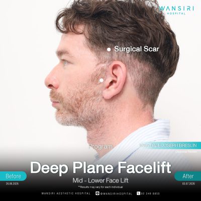 Deep Plane Facelift in Bangkok | Face Lift & Neck Lift | Wansiri Hospital