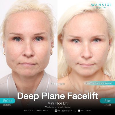 Deep Plane Facelift in Bangkok | Face Lift & Neck Lift | Wansiri Hospital