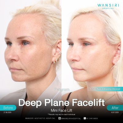 Deep Plane Facelift in Bangkok | Face Lift & Neck Lift | Wansiri Hospital