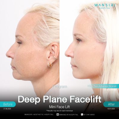 Deep Plane Facelift in Bangkok | Face Lift & Neck Lift | Wansiri Hospital
