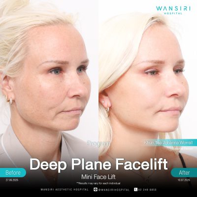 Deep Plane Facelift in Bangkok | Face Lift & Neck Lift | Wansiri Hospital