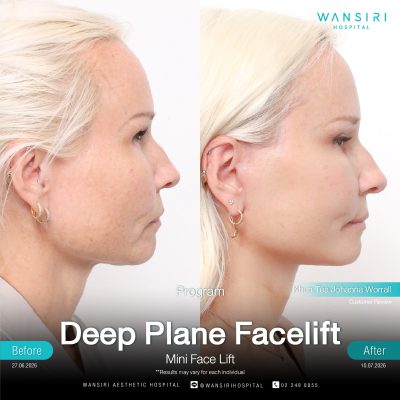 Deep Plane Facelift in Bangkok | Face Lift & Neck Lift | Wansiri Hospital