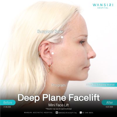 Deep Plane Facelift in Bangkok | Face Lift & Neck Lift | Wansiri Hospital