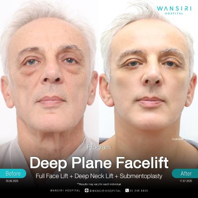 Deep Plane Facelift in Bangkok | Face Lift & Neck Lift | Wansiri Hospital